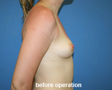 plastic-surgery-breast-augmentation